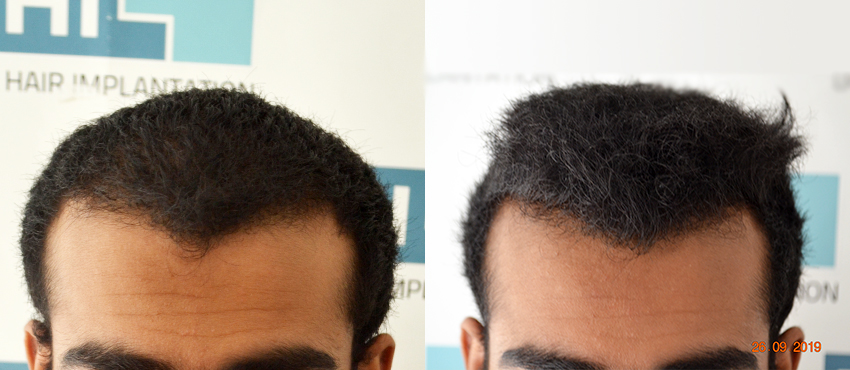 DHI before & after hair transplant results